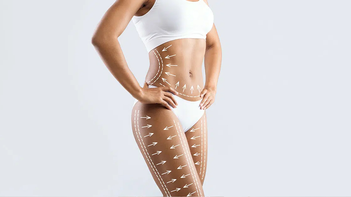 360 Liposuction için temsili görsel