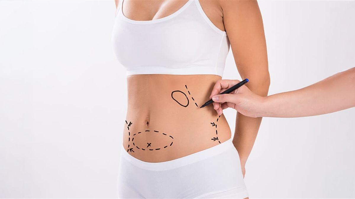 Liposuction için temsili kapak görseli